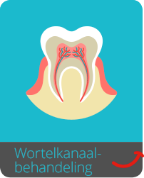 Wortelkanaalbehandeling